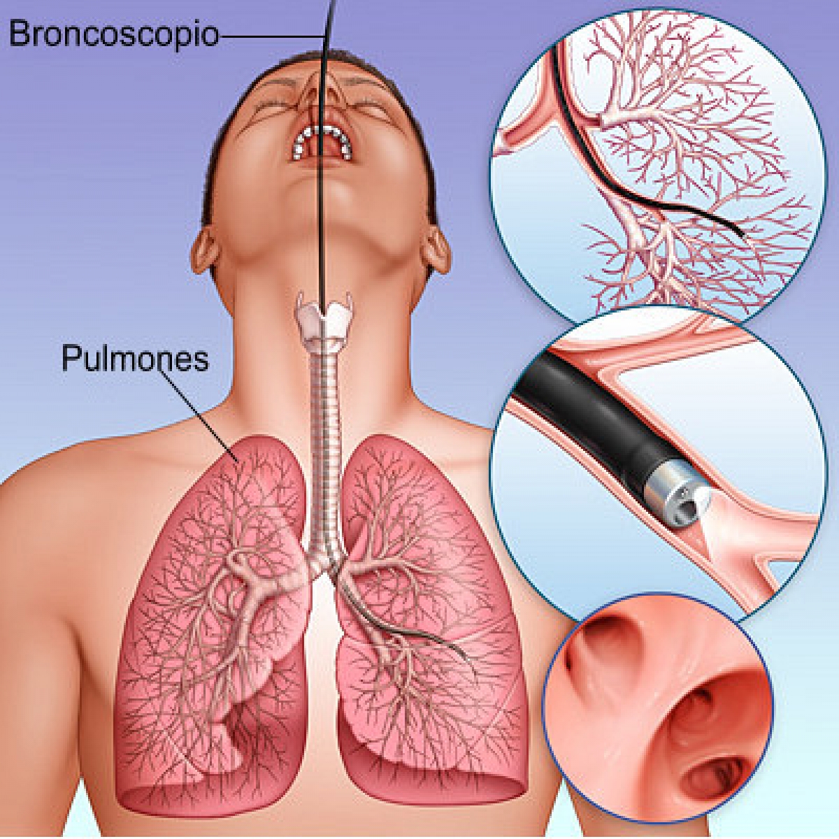 Biopsia pulmonar quirúrgica
